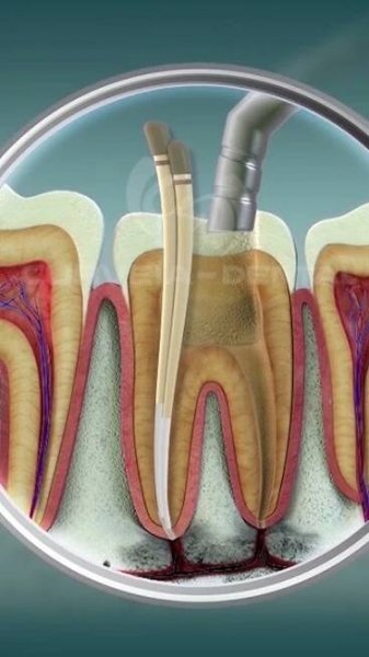 Root Canal Treatment