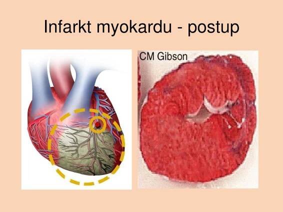 PPT - Nemoci oběhové soustavy PowerPoint Presentation, free download - ID:1816444