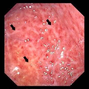 Chronic Gastritis