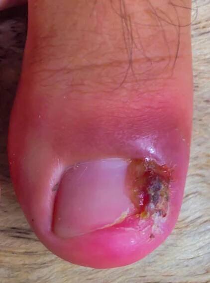 pata je zapálená, což způsobuje bolest a otok způsobený bakteriemi. mělo by být ošetřeno,pozadí - zlatý stafylokok - stock snímky, obrázky a fotky