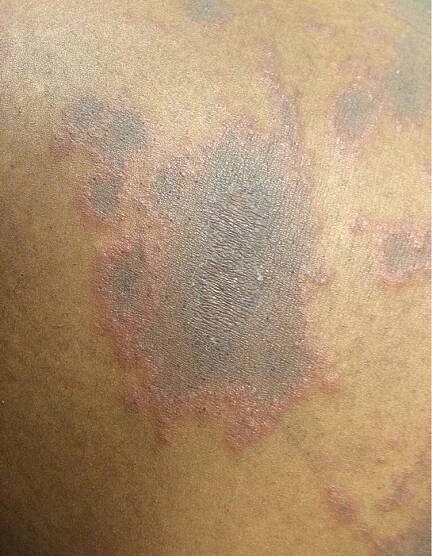 Pruritic Rash in Pregnancy | AAFP