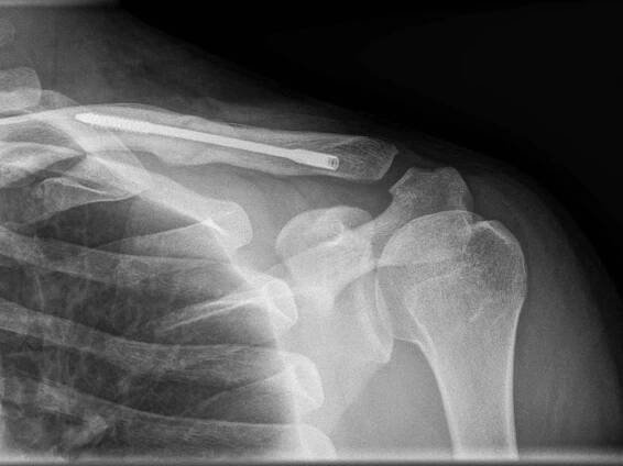 Dual-Trak Clavicle Screw System | Acumed