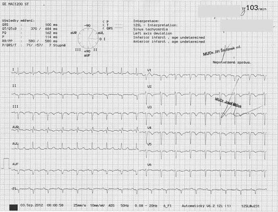 EKG z praxe 19 | Medicína, nemoci, studium na 1. LF UK