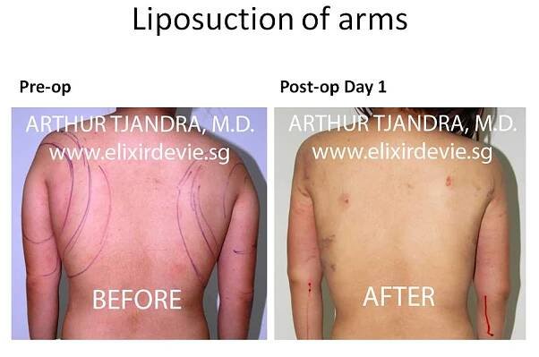 Liposuction Before and After photos by Dr Arthur Tjandra of L’Élixir de Vie Page 1