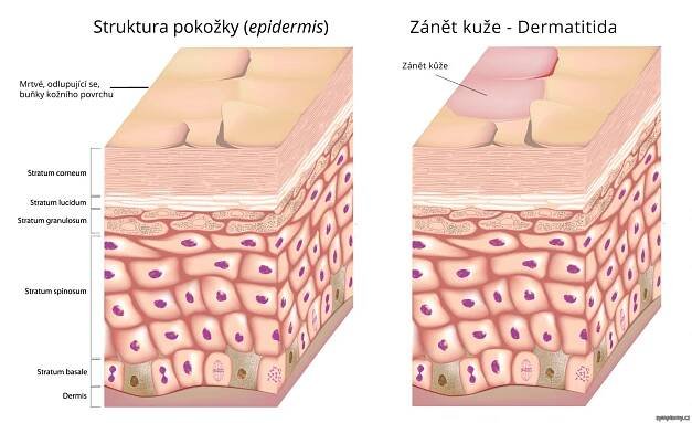 Dermatitida - příznaky a léčba