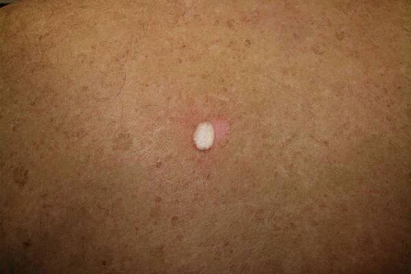 Blister on back post-cryosurgery