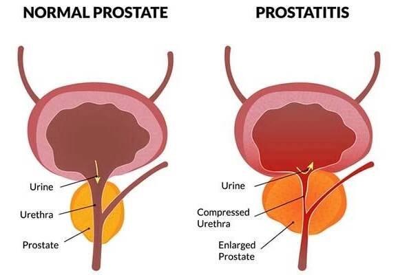 Prostatitis: What It Is and How to Treat It - Mind Vivo AI chatbot