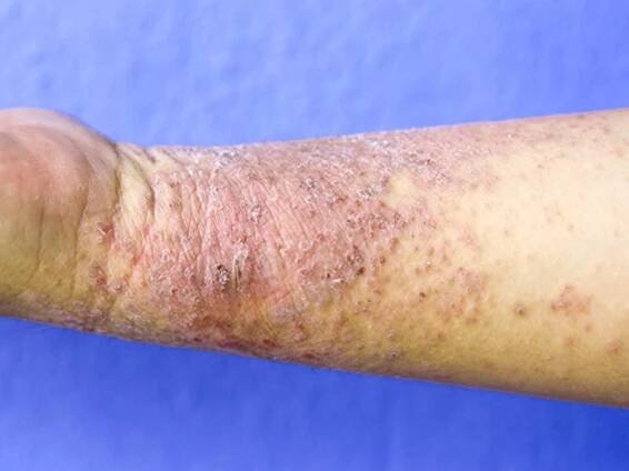 Jak vypadá dermatitida v počáteční fázi?