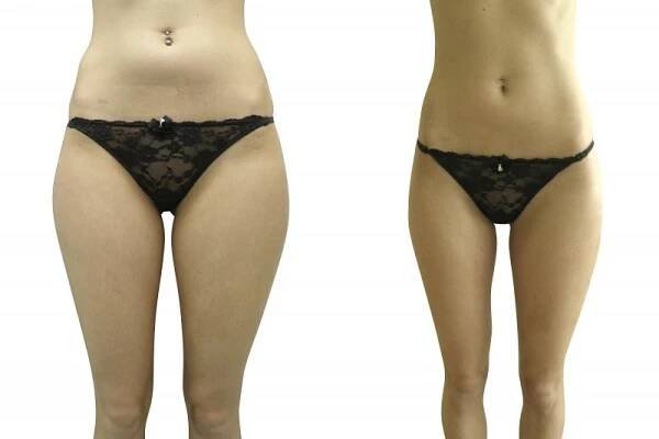 Liposukce – foto před a po | Perfect Clinic