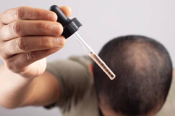 muž používající minoxidil k léčbě mužské plešatosti - seboroická dermatitida - stock snímky, obrázky a fotky