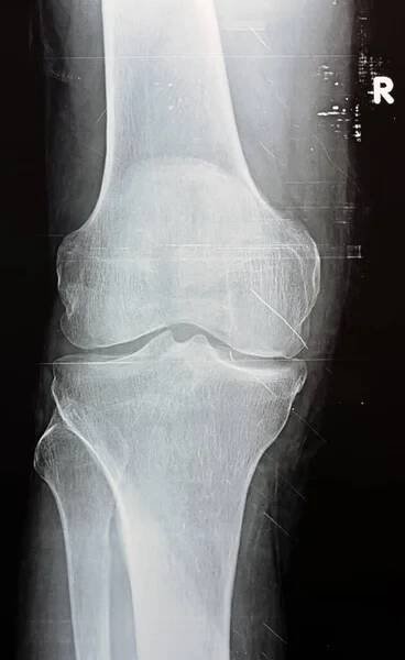 Prostý rentgen pravého kolena ukazuje zjevnou kloubní osteoartritidu dle Kellgrenova a Lawrencova systému pro klasifikaci osteoartritidy s definitivními osteofyty a zúžením prostoru — Stock obrázek