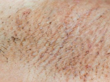 Vyrážka může ukázat infekční kožní nemoc | Zdravestravovani.eu