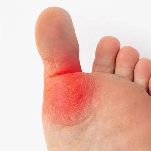 Hallux rigidus: ztuhlý palec nohy | foto: Shutterstock
