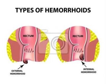 Dva typy hemoroidů jsou vnější a vnitřní. Struktura konečníku. Střeva. dvojtečka. Vnitřní a vnější hemoroidní uzel. Infografy. Vektorové ilustrace na izolované pozadí