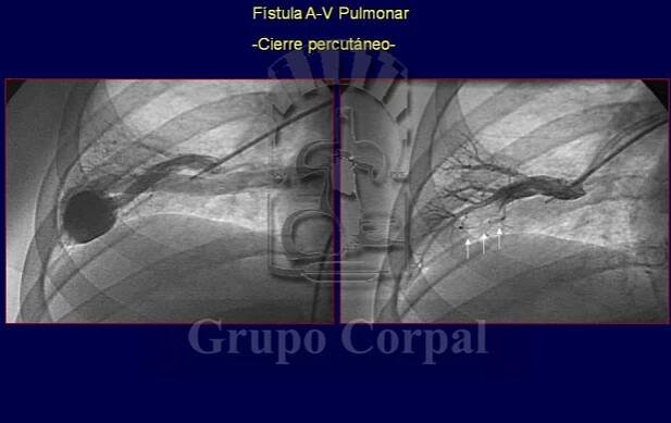 Closure of arterial-venous and venous-systemic fistulas
