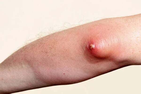 olecranon bursitida a absces v lokti - bursitida - stock snímky, obrázky a fotky