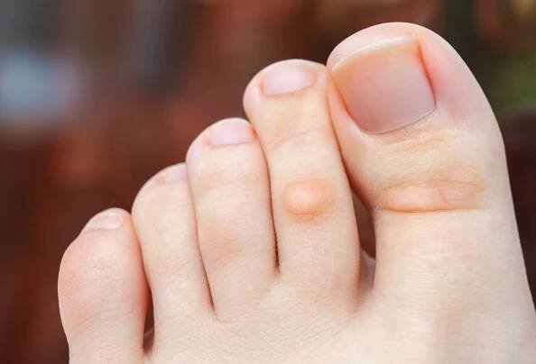 Houston Corn and Calluses