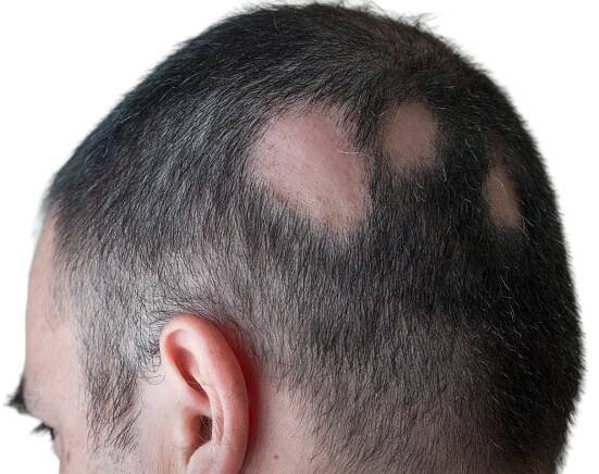 alopecia areata or patchy hair loss baldness over scalp