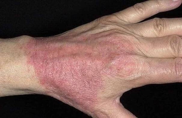 Psoriáza na rukou