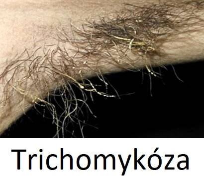 Trichomykóza – co je to – příznaky, příčiny a léčba