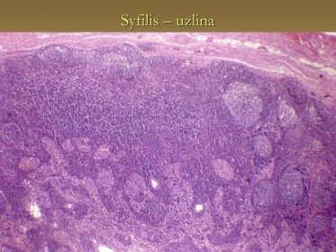Syfilis – uzlina