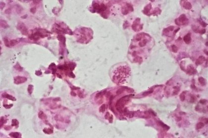 N. gonorrhoeae in pus 2022 Dr Graham BeardsCC Wikimedia Kapavka, nepříjemná pohlavně přenosná nemoc