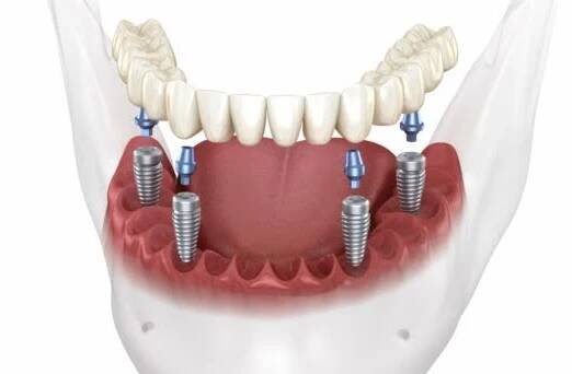 Mandibulární protéza na 4 systému podporovaná implantáty. Lékařsky přesná 3D animace — Stock záběr