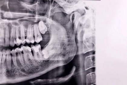 horizontální zub moudrosti na panoramatickém rentgenovém vyšetření zubního zubu - pomocí úst - stock snímky, obrázky a fotky
