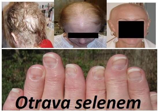 otrava-selenem-selenoza-priznaky-projevy-symptomy