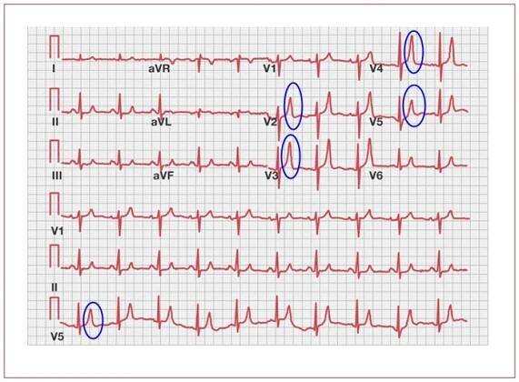 Hyperkalémie, zvýšená hladina draslíku – příznaky, projevy, symptomy