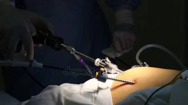 Ruce v rukavicích provádět endoskopická chirurgie v břišní orgány — Stock záběr