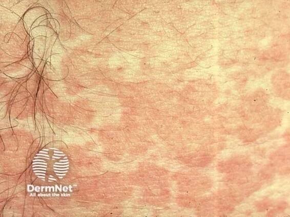 Pityriasis versicolor. Tinea versicolor