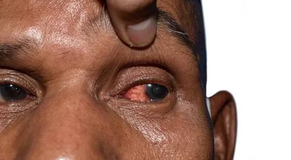 Corneal infection or ulcer called keratitis in Asian old man. — Stock obrázek