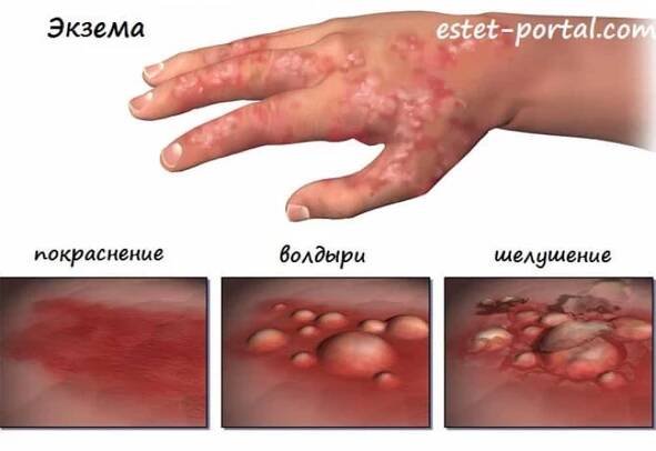 Příznaky ekzémové dermatitidy a léčba onemocnění / Články
