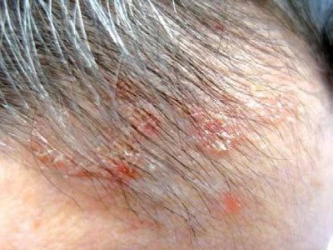 Cradle cap, crusta lactea Diferenciální diagnóza Dermatoskopický obraz ložisek SD vykazuje přítomnost tečkovitých cév a žlutých šupinek (16), přesto i pro zkušeného dermatologa bývá mnohdy obtížné