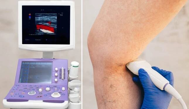 oříznuté ultrazvukové vyšetřovací žíly na noze, žilní trombóza, křečové žíly - lidská žíla - stock snímky, obrázky a fotky