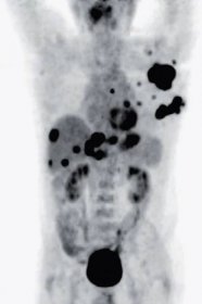 Obr. 1 PET scan před zahájením léčby s ipilimumabem