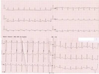 Obr. 5 – EKG natočené na chirurgickém oddělení, normalizace úseku ST 