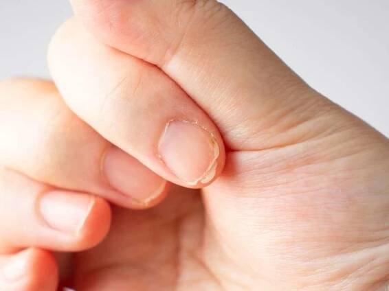 Nail Brittleness: What It Is & Causes