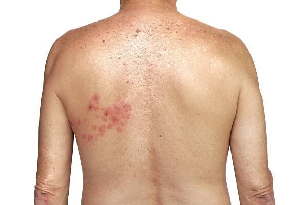 Herpes zoster na pravé straně trupu na bílém pozadí — Stock obrázek
