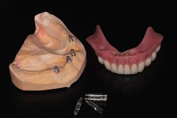 3_snimatelna-proteza-na-mini-implantatoch.jpeg
