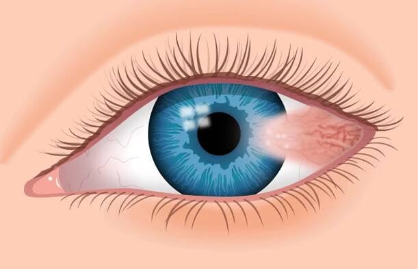 Pterygium Excision - Akstein Eye Center
