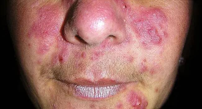 A Visual Guide to Rosacea