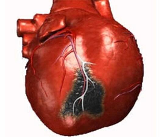 Trombóza mesenterické arterie / Trombóza | Užitečné informace a tipy na péči o sebe. Zdraví, výživa a další.