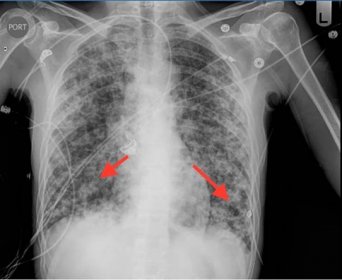 Pneumocystis Pneumonia Chest X Ray | My XXX Hot Girl