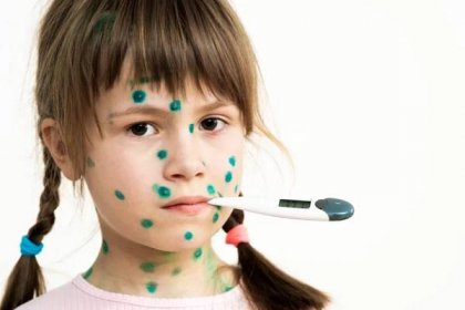 Děti a neštovice: Jak o pupínky pečovat, na co si dát pozor?
