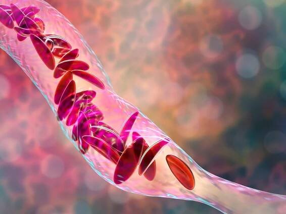 Canakinumab in children and young adults with sickle cell anaemia - BJH