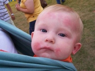 Vodní akné na těle dítěte: vodní akné a akné na obličej, ruce a nohy, na zadní straně