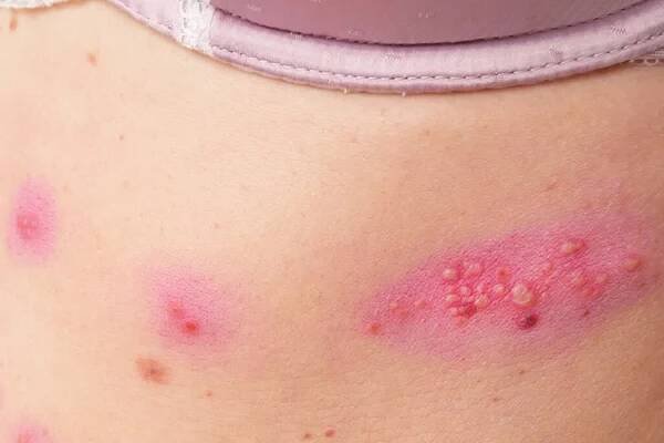 Kožní vyrážka léčba na těle ženy. pásový opar, choroba, herpes zoster, virus varicella-zoster. kožní vyrážka a puchýře na těle — Stock obrázek