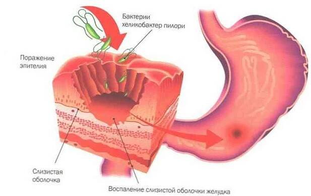 Léčba gastritidy u dětí / Gastroenterologie | Užitečné informace a tipy na péči o sebe. Zdraví, výživa a další.